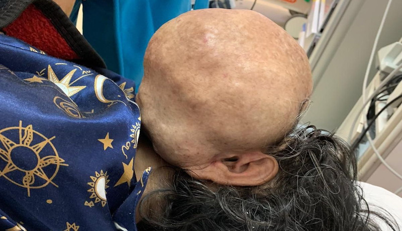 Premieră medicală la Caransebeș: tumoră facială de peste trei kilograme extirpată de dr. Singh Bhupinder!